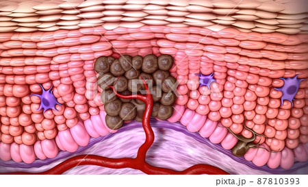 3d medical illustration of skin cancer: Squamous cell carcinoma, basal cell cancer 87810393