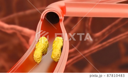 Atherosclerosis, plaque buildup and thickening of the arteries in the inner lining of an artery 3D medical illustration 87810483
