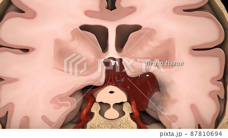 3D medical illustration of brain injury 87810694