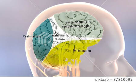Amyloid Precursor Protein Processing and Alzheimer s Disease 87810695