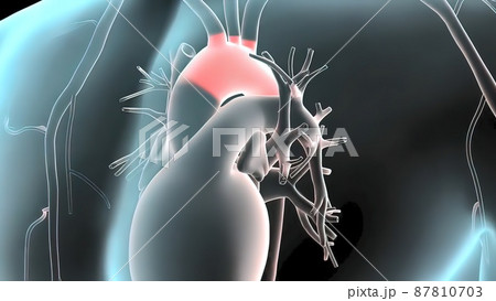 3D medical illustration of pulsatile Abdominal Aortic Aneurysm 87810703
