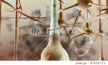 Amyloid Plaques. The beta-amyloid protein involved in Alzheimer's disease Amyloid Plaques. The beta-amyloid protein involved in Alzheimer's disease 87810721