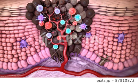 3d medical illustration of skin cancer: Squamous cell carcinoma, basal cell cancer 87810872