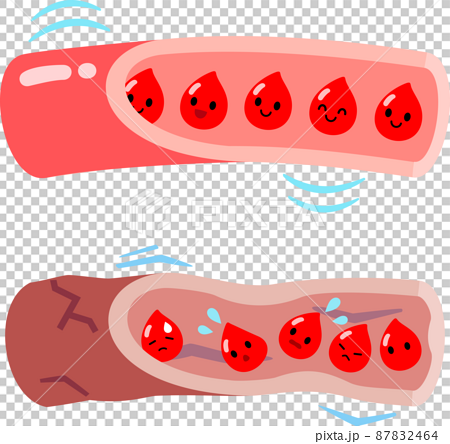 柔らかい血管と硬い血管の血流のイメージのイラスト素材