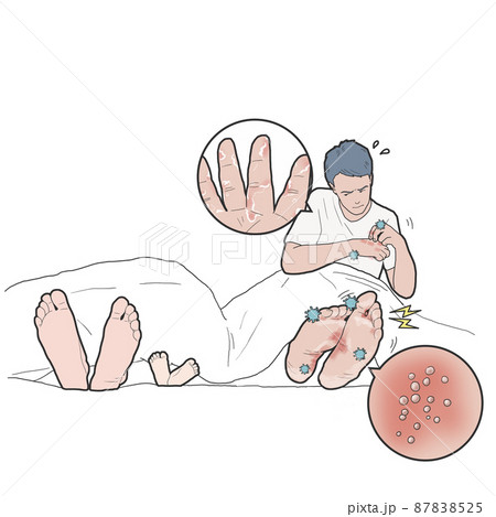 症状 疾患 水虫 87838525