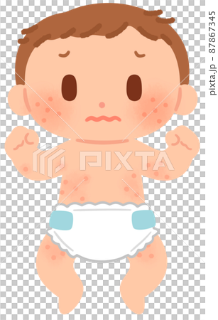 Baby with eczema on the body - Stock Illustration [87867345] - PIXTA