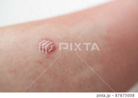 ブヨに刺されて水ぶくれになった足の患部 87875008