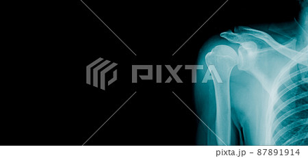 x-ray shoulder banner design in blue x-ray shoulder banner design in blue 87891914