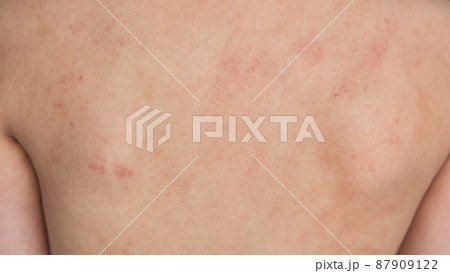boy back rash skin allergy due to cow protein 87909122