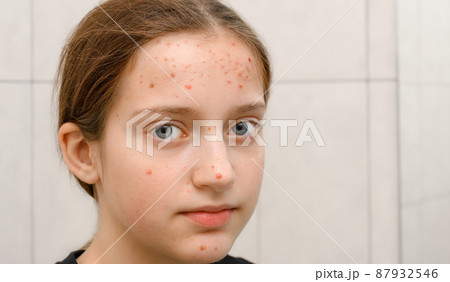face of a teenage girl with pimples, acne on the skin, portrait of puberty girl 87932546