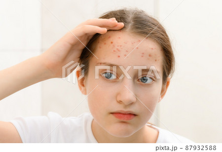 portrait of a teenage girl touches her face with pimples, acne on the skin portrait of a teenage girl touches her face with pimples, acne on the skin 87932588