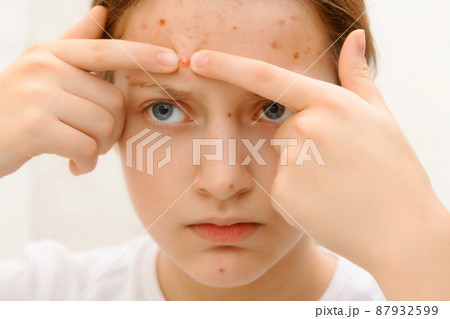 portrait of a teenage girl touches her face with pimples, acne on the skin, she crushes pimples 87932599