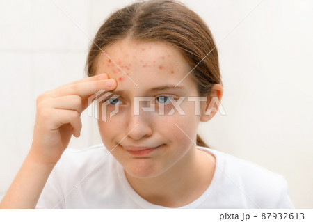 a disappointed teenage girl looks in the mirror at her face with pimples, touches her face, she is upset and has bad emotions a disappointed teenage girl looks in the mirror at her face with pimples, touches her face, she is upset and has bad emotions 87932613