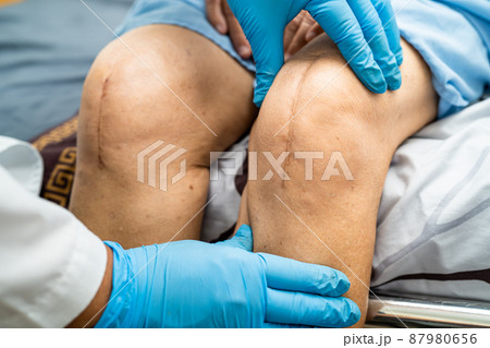 Asian senior or elderly old lady woman patient show her scars surgical total knee joint replacement Suture wound surgery arthroplasty on bed in nursing hospital ward, healthy strong medical concept. 87980656