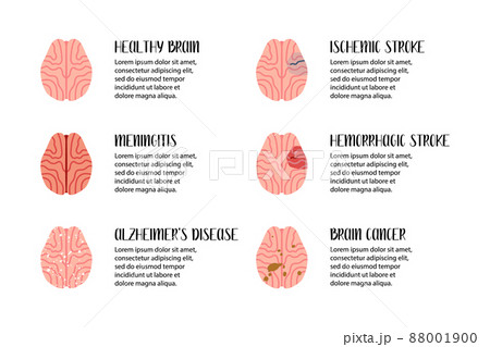 Brain diseases. Meningitis, ischemic and hemorrhagic stroke, alzheimer's disease, cancer. Neurobiology. Vector flat illustration. Perfect for flyer, medical brochure, banner, landing page, website 88001900