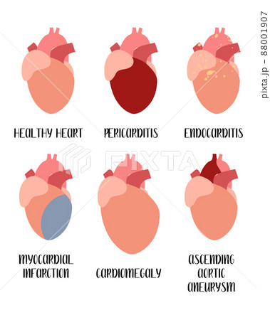 Heart, cardiovascular diseases. Pericarditis, endocarditis, myocardial infarction, cardiomegaly, aneurysm. Cardiology. Vector flat illustration. For flyer, medical brochure, banner, landing page, 88001907
