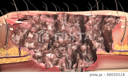 Serious burns on human skin Serious burns on human skin 88030528