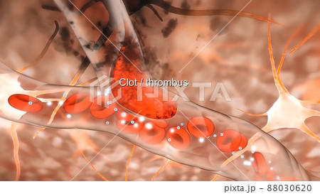 Brain Hemorrhagic Stroke Due To Aneurysm Rupture. Brain Hemorrhagic Stroke Due To Aneurysm Rupture. 88030620