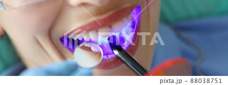 Young woman treating teeth with cordless LED curing light machine closeup 88038751