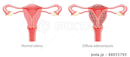 Diffuse Adenomyosis Human anatomy Female Sick and normal reproductive system organs. Location scheme Cross section  88055793