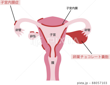 子宮のイラスト 子宮のイラスト 88057103