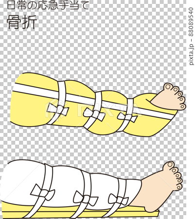 First aid for a broken leg First aid for a broken leg 88089540