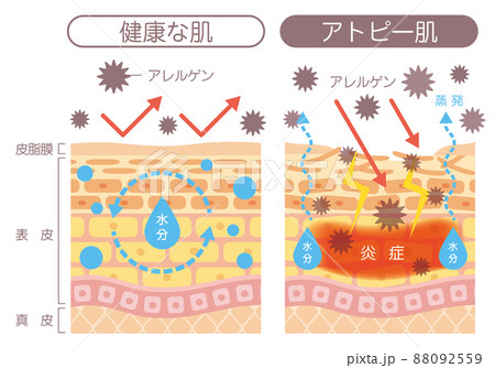 肌の構造_アトピー肌 肌の構造_アトピー肌 88092559