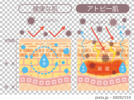 Skin structure_atopic skin 88092559