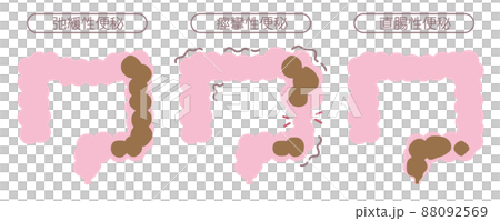 便秘の種類 88092569