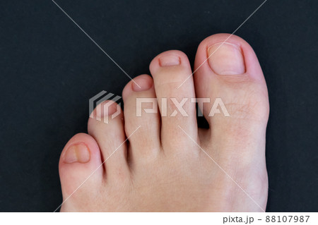 Female feet with big double little toe on black background Female feet with big double little toe on black background 88107987