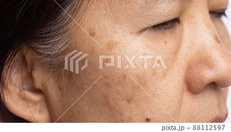 Menopausal women worry about melasma on face. Menopausal women worry about melasma on face. 88112597