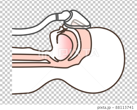 Illustration of CPAP 88113741