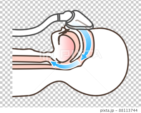 Illustration of CPAP Illustration of CPAP 88113744