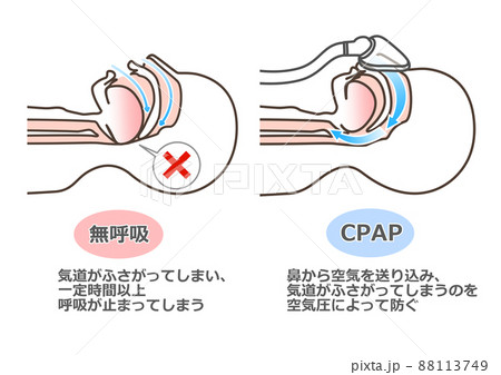 CPAPの図解 88113749
