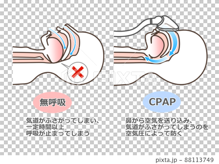 Illustration of CPAP 88113749