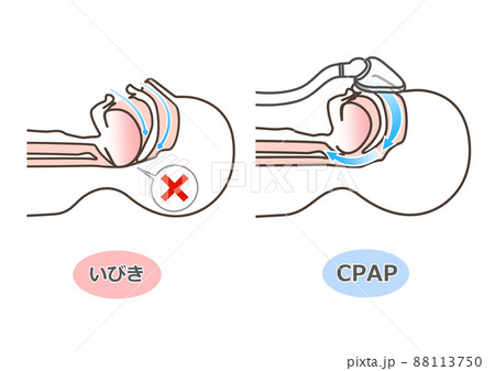CPAPの図解 88113750