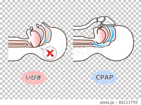 CPAPの図解 88113750