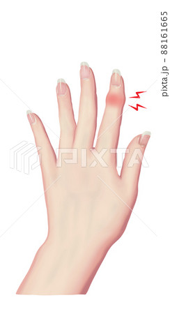 リアル調　人差し指の第一関節が腫れた女性の手 88161665