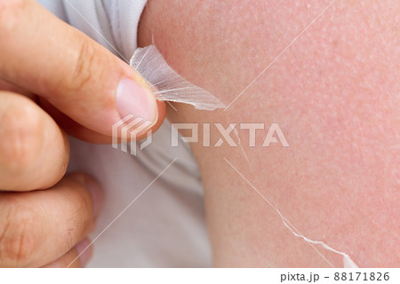 peeling of skin after burned by sunlight. not using sunscreen 88171826