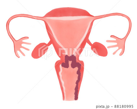 子宮頸がんの病期と進行度（ⅢA期） 88180995