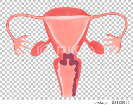 子宮頸がんの病期と進行度（ⅢA期） 88180995