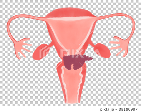 子宮頸がんの病期と進行度(ⅡB期) 子宮頸がんの病期と進行度(ⅡB期) 88180997