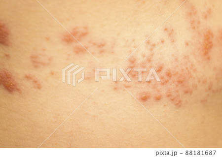 帯状疱疹イメージ 88181687
