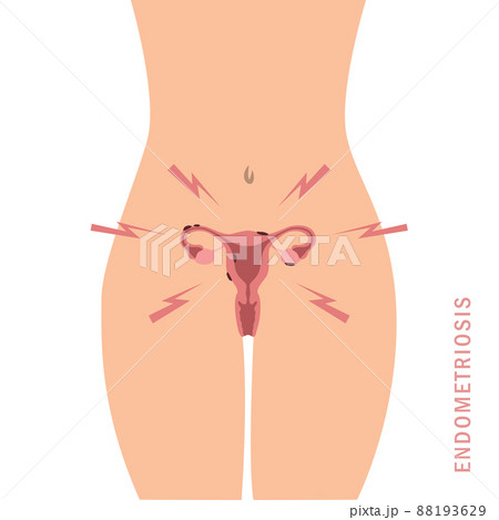 endometriosis info graphic womens health uterus anatomy 88193629