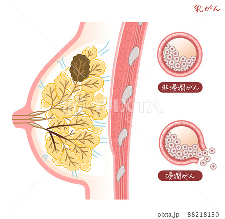 Illustration of breast cancer, breast cancer, - Stock