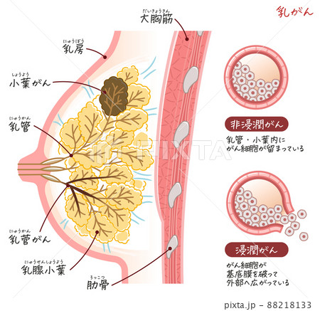 乳がん・乳癌・乳ガン・Breast cancerのイラスト 88218133