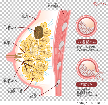 乳がん・乳癌・乳ガン・Breast cancerのイラスト 88218133