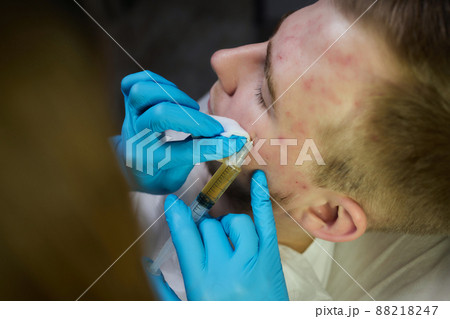 Injection at spa salon. Doctor hands in gloves. Closeup. Pretty male patient. Beauty treatment. Healthy skin procedure. Young man face. Plasmolifting rejuvenation. Injection at spa salon. Doctor hands in gloves. Closeup. Pretty male patient. Beauty treatment. Healthy skin procedure. Young man face. Plasmolifting rejuvenation. 88218247
