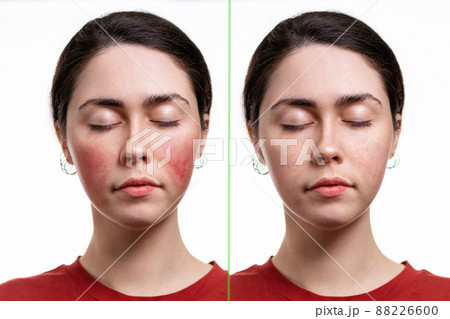 Two portraits of a young Caucasian woman with rosacea on her cheeks. Before and after. White background. The concept of rosacea and inflammation on the face Two portraits of a young Caucasian woman with rosacea on her cheeks. Before and after. White background. The concept of rosacea and inflammation on the face 88226600
