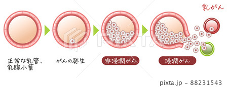 乳がん・乳癌・乳ガン・Breast cancer・浸潤がん・非浸潤がんのイラスト 乳がん・乳癌・乳ガン・Breast cancer・浸潤がん・非浸潤がんのイラスト 88231543